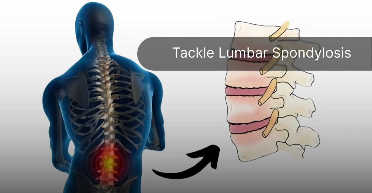 Tackle Lumbar Spondylosis Without Surgery