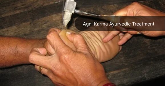 Agni Karma Ayurvedic Treatment For Body Pain