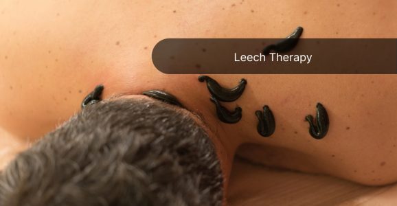 Leech Therapy