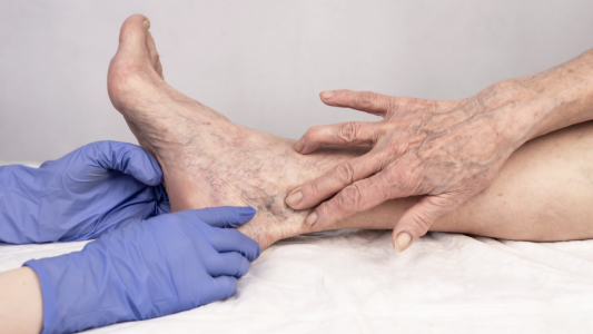 Effective, Natural Varicose Veins Treatment in Ayurveda
