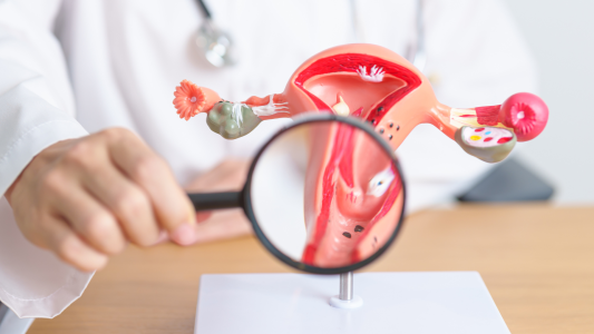 Ayurvedic Treatment for PCOD: Holistic Root Cause Management